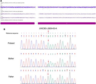 Case Report: Complete Maternal Uniparental Disomy of Chromosome 2 With a Novel UNC80 Splicing Variant c.5609-4G> A in a Chinese Patient With Infantile Hypotonia With Psychomotor Retardation and Characteristic Facies 2